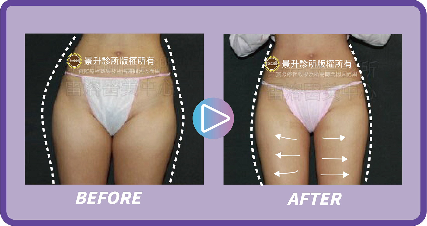 大腿抽脂改善什麼部位? - 景升診所 ▲大腿抽脂環抽減少大腿內側局部頑固脂肪堆積