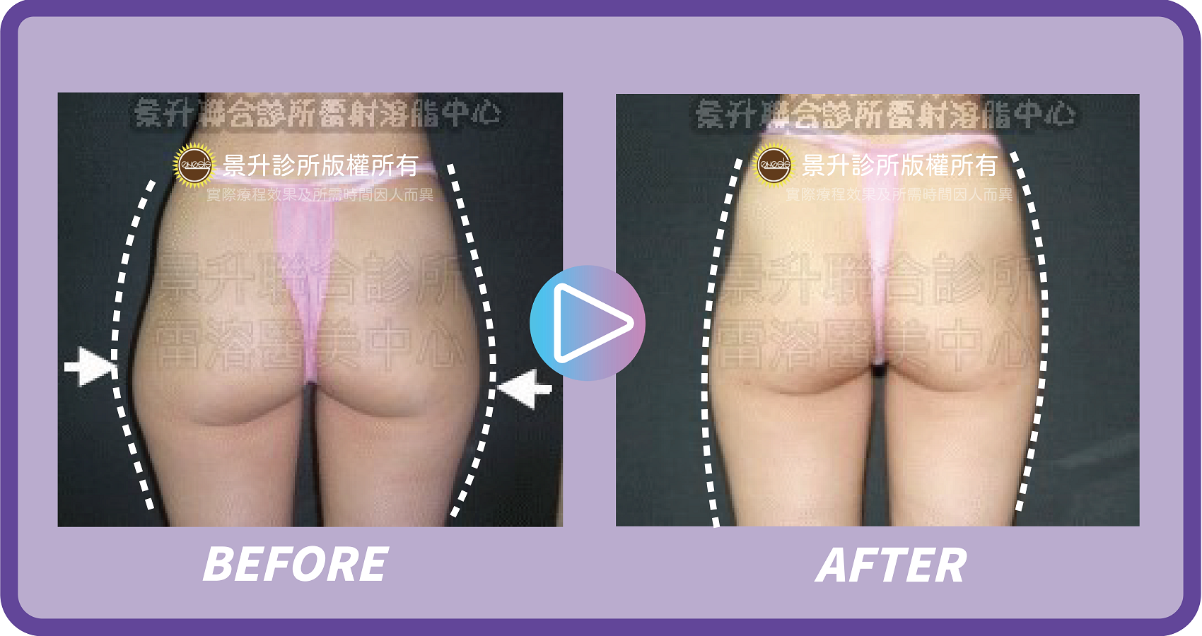 大腿抽脂改善什麼部位? - 景升診所 ▲ 大腿抽脂環抽配合臀部外側上緣抽脂,雕塑下半身曲線