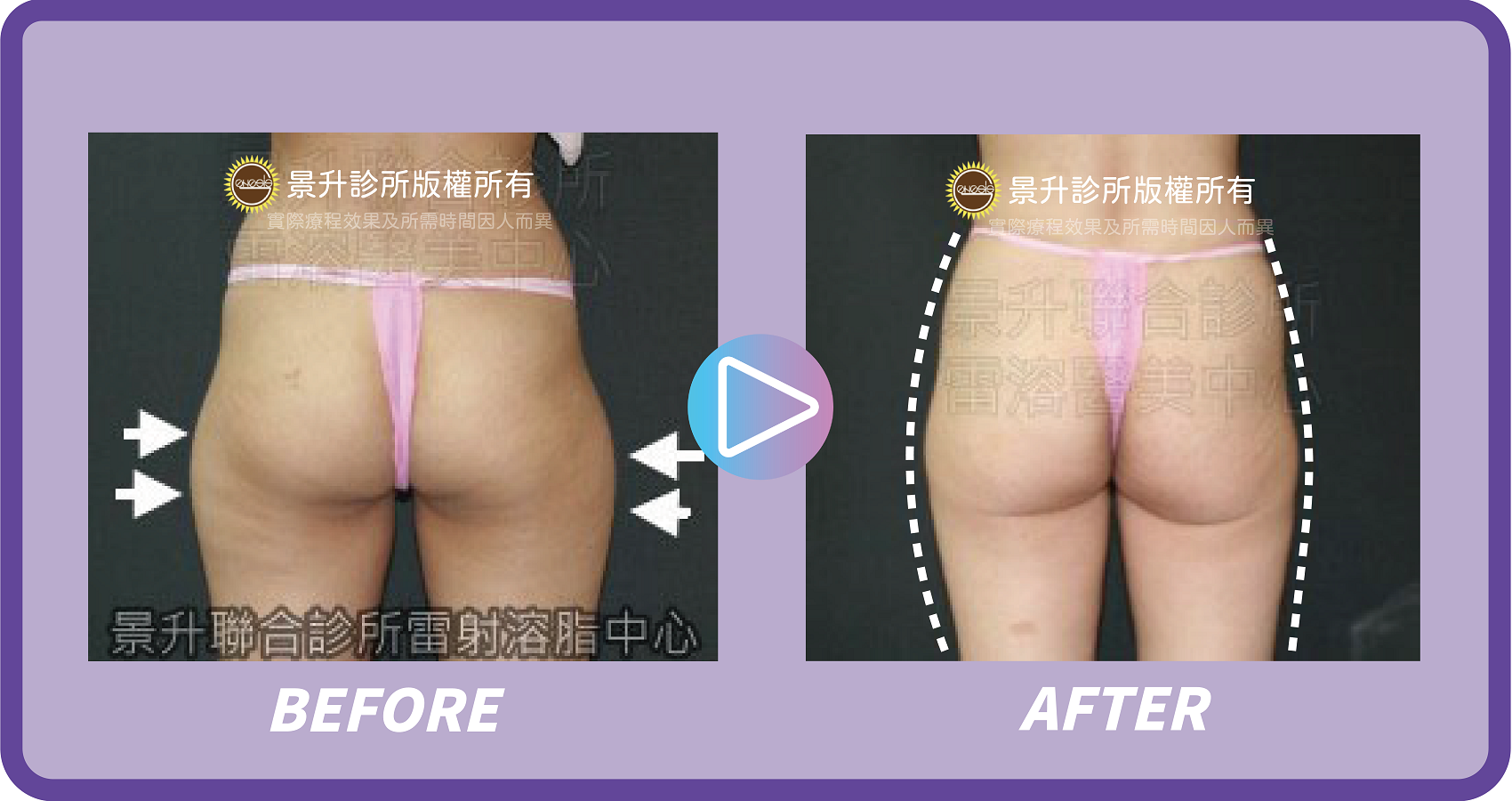 大腿抽脂改善什麼部位? - 景升診所 ▲ 大腿抽脂環抽配合臀部外側上緣抽脂 雕塑下半身曲線