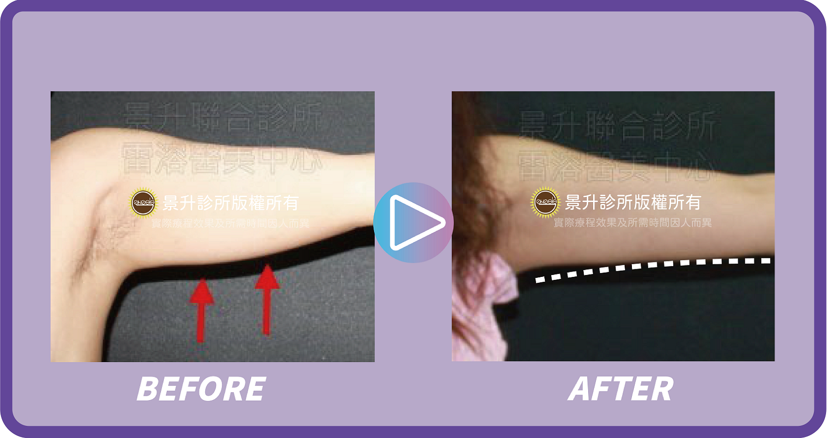 景升診所 行事曆 - 景升診所 景升診所 自體脂肪論文 連續七年刊登國際期刊 景升診所 行事曆 瘦手臂1