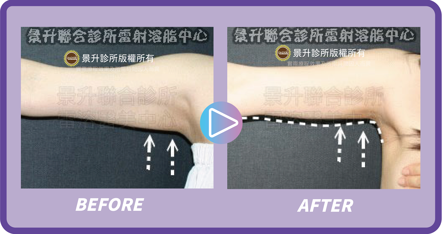 景升診所 行事曆 - 景升診所 景升診所 自體脂肪論文 連續七年刊登國際期刊 景升診所 行事曆 瘦手臂3