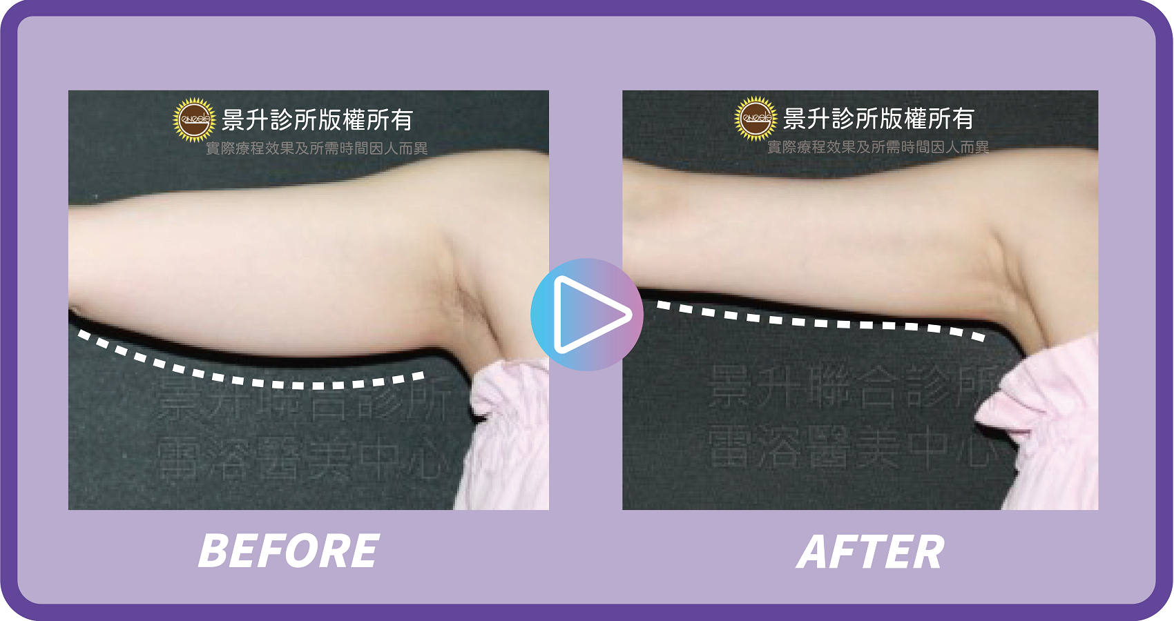 景升診所 行事曆 - 景升診所 景升診所 自體脂肪論文 連續七年刊登國際期刊 景升診所 行事曆 瘦手臂5