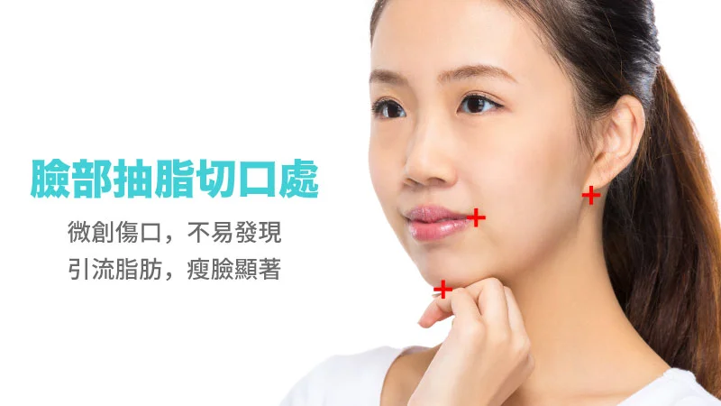 瘦臉＿抽脂瘦臉傷口微創無痕！＿景升診所