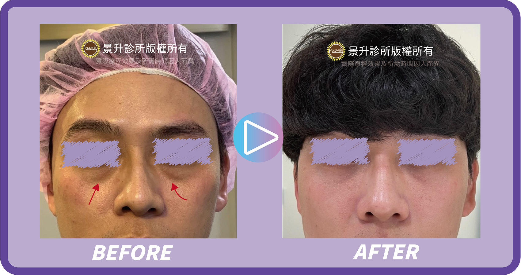 眼袋手術揮別憔悴老態 不動刀也能治療浮腫眼袋 - 景升診所 景升診所 自體脂肪論文 連續七年刊登國際期刊 眼袋手術揮別憔悴老態 不動刀也能治療浮腫眼袋 眼袋案例1 1