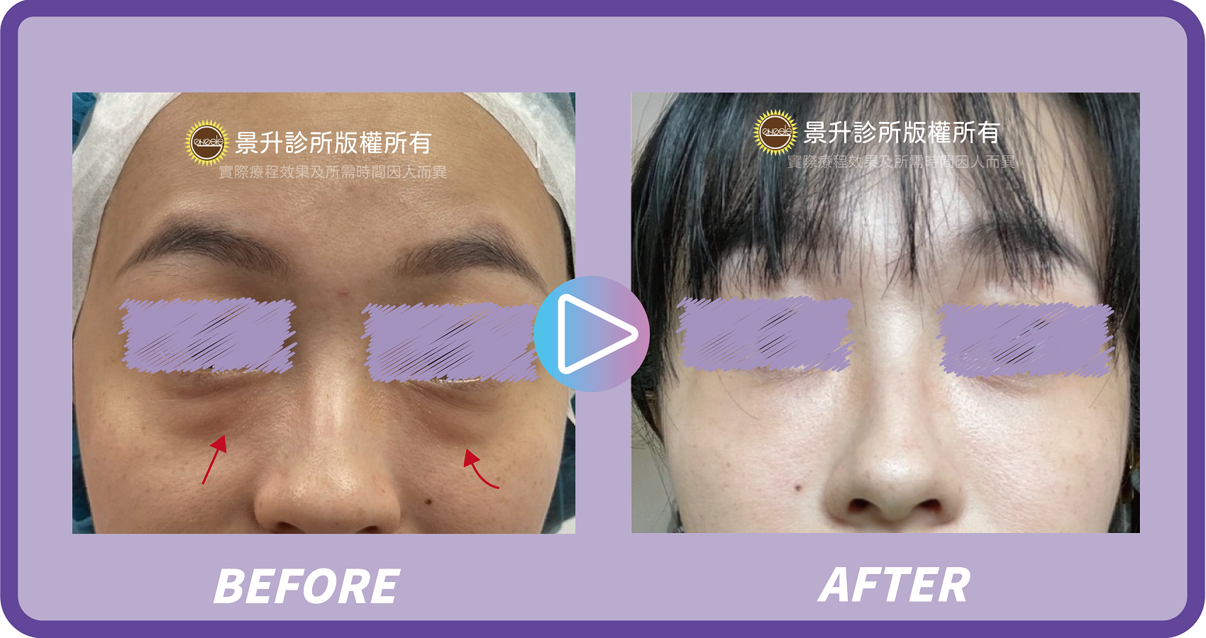 眼袋手術揮別憔悴老態 不動刀也能治療浮腫眼袋 - 景升診所 景升診所 自體脂肪論文 連續七年刊登國際期刊 眼袋手術揮別憔悴老態 不動刀也能治療浮腫眼袋 眼袋案例2 2