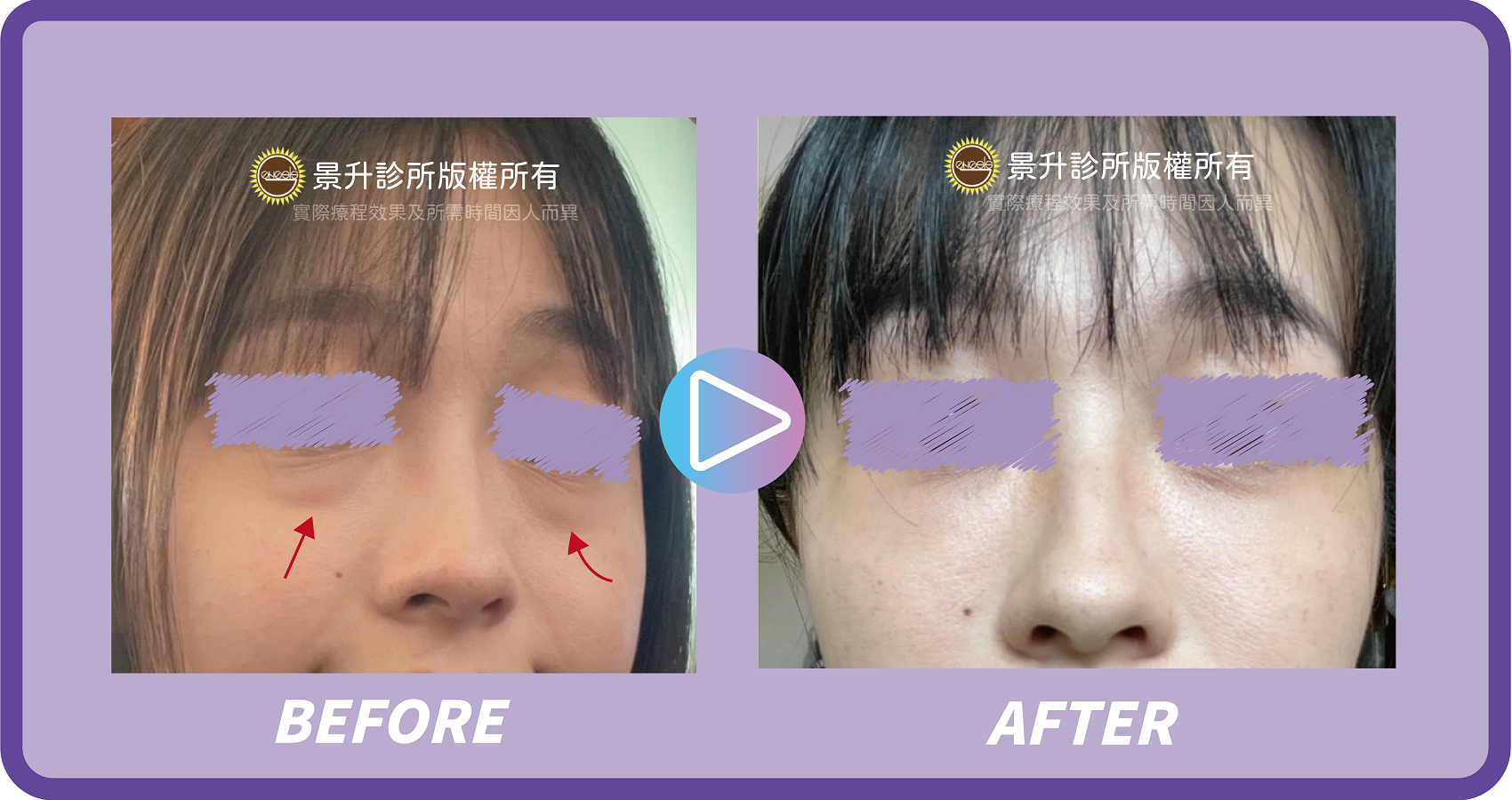 眼袋手術揮別憔悴老態 不動刀也能治療浮腫眼袋 - 景升診所 景升診所 自體脂肪論文 連續七年刊登國際期刊 眼袋手術揮別憔悴老態 不動刀也能治療浮腫眼袋 眼袋案例3