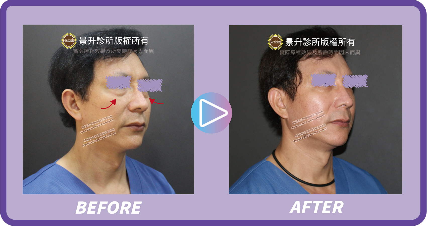 眼袋手術揮別憔悴老態 不動刀也能治療浮腫眼袋 - 景升診所 景升診所 自體脂肪論文 連續七年刊登國際期刊 眼袋手術揮別憔悴老態 不動刀也能治療浮腫眼袋 眼袋案例4