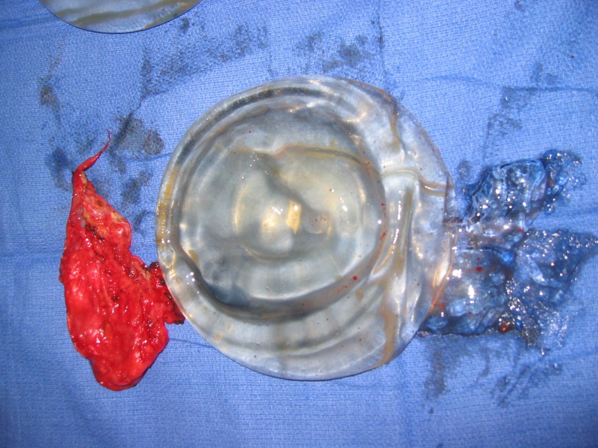 破裂的果凍矽膠假奶和外漏的半固態矽膠，左邊紅色的是莢膜