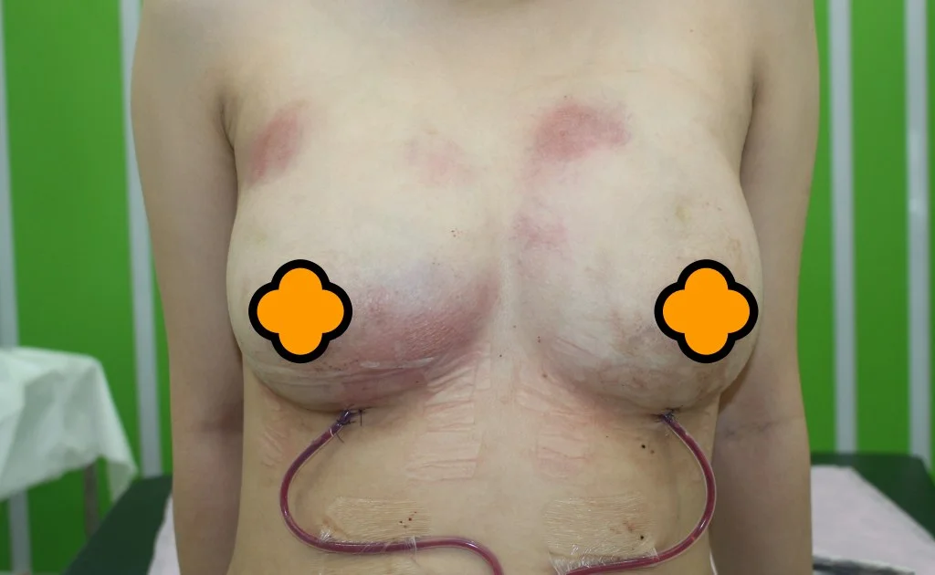 自體脂肪隆乳為什麼會產生敗血症? 4 自體脂肪隆乳為什麼會產生敗血症?