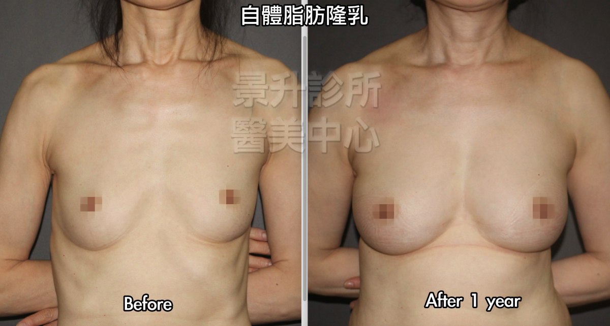 自體脂肪隆乳一年後的效果，右乳打入380 mL，左乳打入355 mL
