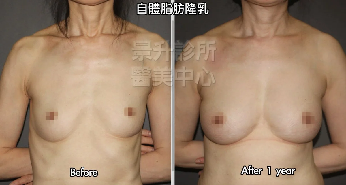 自體脂肪隆乳 成功案例 5 自體脂肪隆乳一年後的效果,右乳打入380 mL,左乳打入355 mL