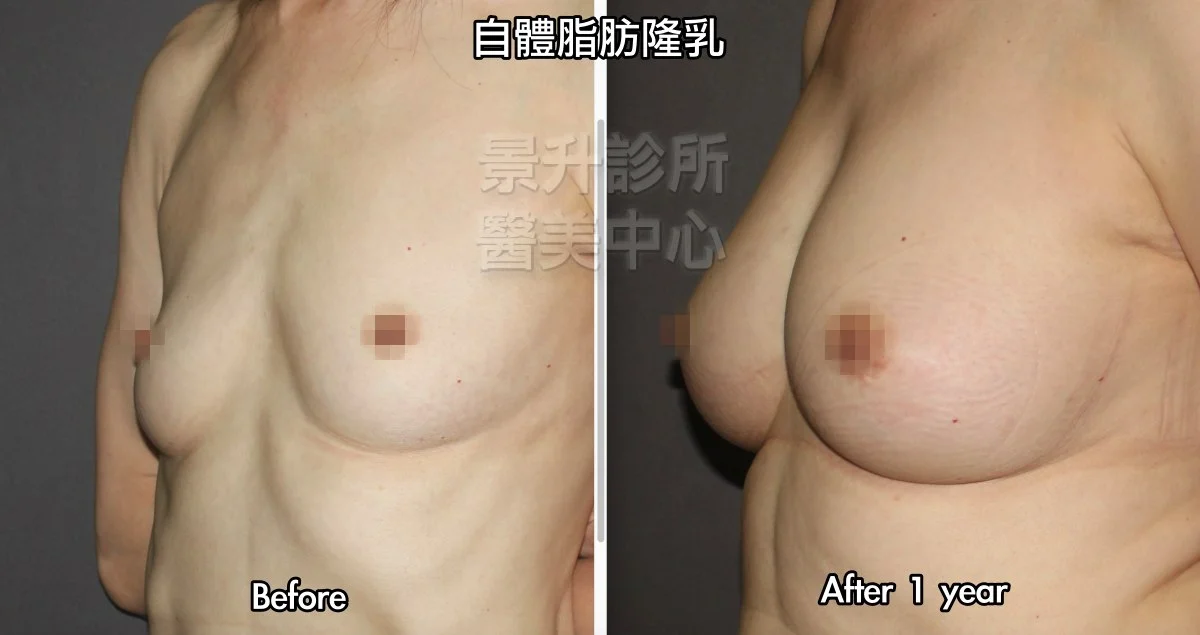 自體脂肪隆乳 成功案例 6 自體脂肪隆乳一年後的效果