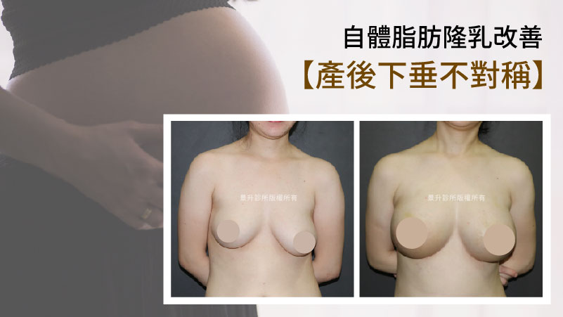 自體脂肪隆乳＿改善產後萎縮胸型＿景升診所