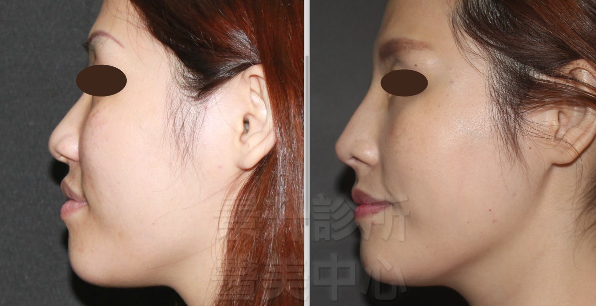 玻尿酸隆鼻後，鼻中柱變明顯、鼻尖更高、臉更立體